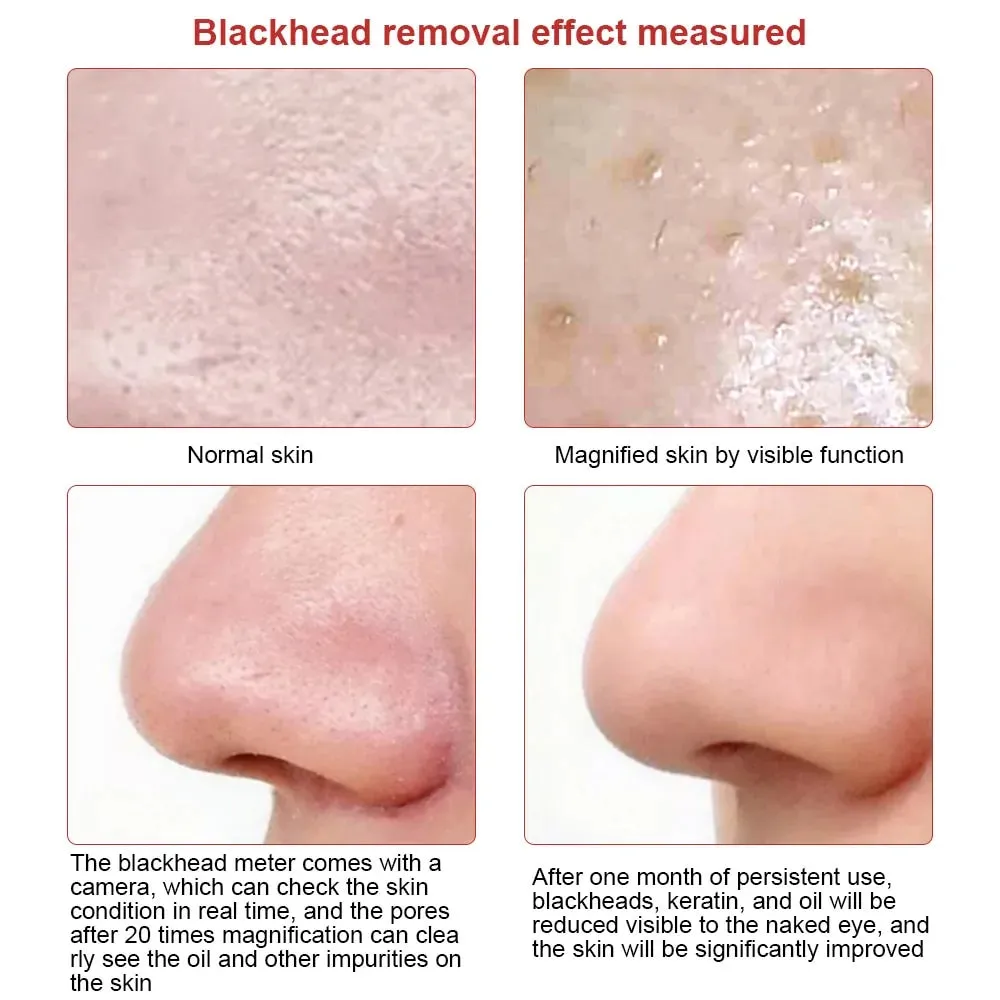 Visible Camera Blackhead Remover Vacuum Suction